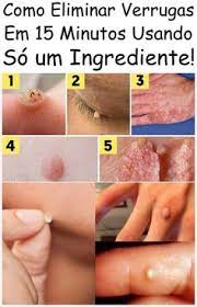 65 Ideias De Verrugas Verrugas Como Eliminar Verrugas Remover Verrugas