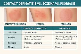 Image result for contact dermatitis