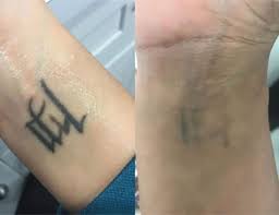 Clean slate laser is known worldwide for our flawless tattoo removal results. Laser Tattoo Removal Nyc Manhattan Queens Glamoi Med Spa