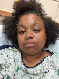 Bariatric surgery recovery and gas pain management after bypass surgery