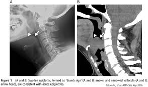 Image result for Epiglottitis