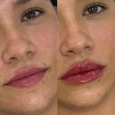 Que preenchimento Labial foi essse ??? 🫶🏻🫶🏻🫶🏻🫶🏻 PERFEITOOOO!!!!!!!