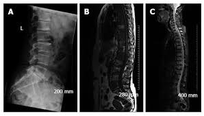 Mixed sclerotic lesions, including right sixth rib head as suggested on cxr, left lateral eighth rib and sternal sclerosis. Imaging Of Bone Metastasis An Update