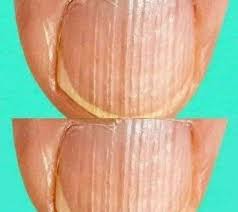 Just for Jokes and Fun - Rippled fingernails reveal secrets of possible  disease Having striped nails might mean that your body is... Check the  comments 👇 | Facebook