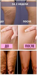 как убрать мертвую кожу с ног с помощью аспирина Cellyulit Ischeznet Volshebnym Obrazom Drevnee Proverennoe Sredstvo Best Healthy Diet Health Fitness Nutrition Health And Beauty