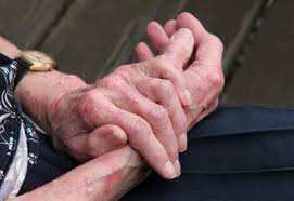 We did not find results for: Angioedema Pembengkakan Karena Gatal Gatal