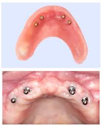 Bonjour, ma mère a 90 ans. Dentier Fixe Sur Implant Dentier Clipse Sur 4 Implants 2925 En 3 Jours