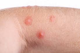 Bites usually come in groups of three or four, or in a straight line, locating around the ankles or legs. Flea Bites Vs Bed Bug Bites Difference In Symptoms And Treatments