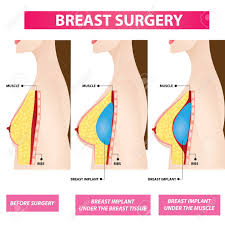 Logical Natrelle Breast Implant Size Chart 2019