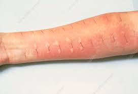 Image result for Skin Testing