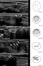Most cases of thyroid cancer can be cured with treatment. Relationship Between Morphologic Characteristics Of Ultrasonic Calcification In Thyroid Nodules And Thyroid Carcinoma Ultrasound In Medicine And Biology