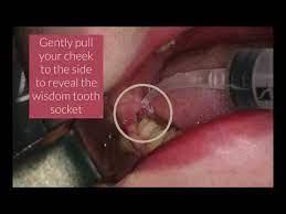 The empty wisdom tooth hole (socket) left behind after surgery takes between 3 and 4 months to heal completely. Postoperative Care Preoperative Care Innovative Implant Oral Surgery