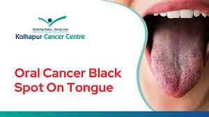 Image result for black tongue symptoms