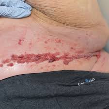 Image result for Erythrasma