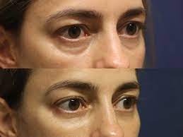 Maybe you would like to learn more about one of these? Tratamiento De Las Ojeras Dr Martin Devoto
