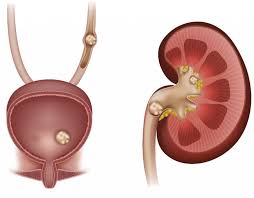 Pengontrolan hormonal terhadap reabsorpsi tubulus. 6 Penyakit Sistem Urine Ini Bisa Fatal Jangan Dibiarkan