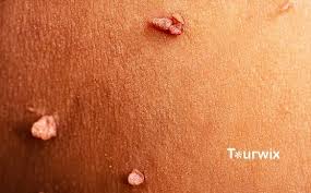 Image result for human papillomavirus symptoms