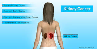 Being male, obese and a smoker increases your risk of kidney cancer. Kidney Cancer Stages Causes Risk Factors Signs Symptoms Tests Treatment Surgery