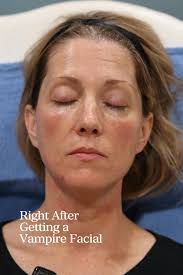 Ready for a more youthful, even complexion? A Vampire Facial helps smooth  texture, minimize pores, calm acne, and revive dull skin — leaving you  tighter, brighter, and deeply hydrated. If you’re ...