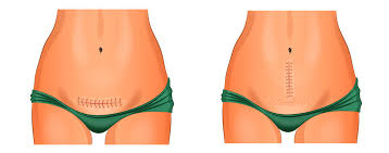 Der behandelnde arzt kann das am besten beurteilen. Kaiserschnittnarbe Pflege Nach Kaiserschnitt Und Bei Entzundungen