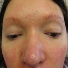 In most cases, the itching is accompanied by a flaky skin and eyebrow hair loss. What S Causing These Keratotic Papules And Loss Of Eyebrows Consultant360