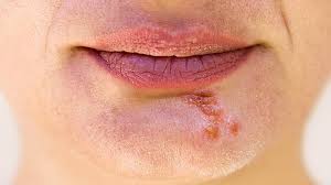 Herpes Im Gesicht Was Ist Zu Beachten Zava Dred