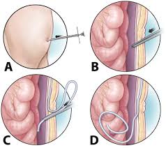 Https Thejns Org Downloadpdf Journals J Neurosurg Pediatr 11 5 Article P558 Pdf