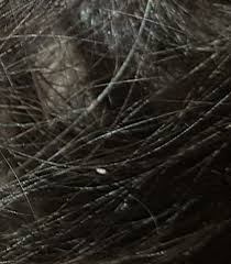 Sind Das Nissen In Mein Haar Haare Lause