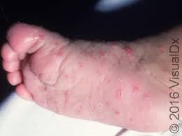 Image result for scabies human children