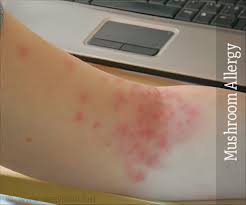 We did not find results for: Mushroom Allergy Causes Symptoms Diagnosis Treatment Prevention