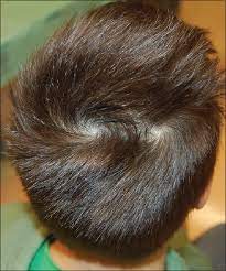 Good thing im not planning to have anymore kids. Scalp Hair Whorl Patterns In Patients Affected By Neurofibromatosis Type 1 A Case Control Study Sechi A Neri I Patrizi A Starace M Savoia F Leuzzi M Caposiena Caro Rd Piraccini Bm