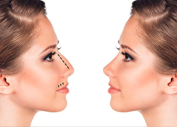 Perfil facial demostrativo relacionado con rinoplastia