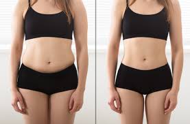 Image result for Liposuction