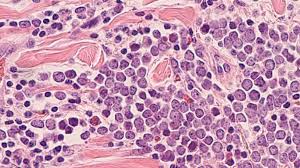 Image result for Merkel Cell Carcinoma
