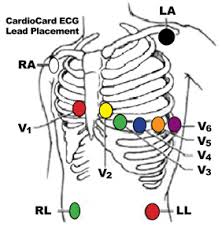 ehhop ehhop ekg