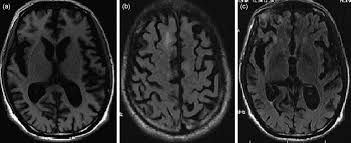 Image result for Neurosyphilis