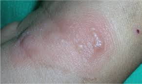 How long the disease lasts also depends on the stage of the disease. Nongenital Herpes Simplex Virus American Family Physician