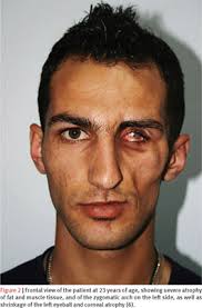 Parry-Romberg syndrome: a mini review.