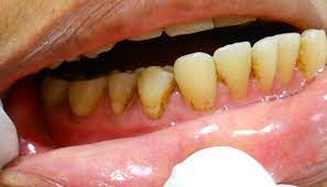 The procedure begins with a short preparation to cover the lips and gums, leaving the teeth exposed. Dark Brown Extrinsic Staining Due To Iron Containing Medicament Download Scientific Diagram