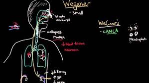 Image result for Microscopic Polyangiitis