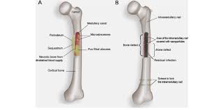 Image result for Osteomyelitis