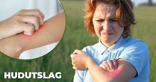 We did not find results for: Hudutslag En Guide Om Olika Blemmor Pa Skinnet