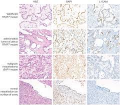 Malignant peritoneal mesothelioma (mpm) is an aggressive neoplasm that arises from the lining mesothelial cells of the peritoneum and spreads extensively within the confines of the abdominal cavity. Well Differentiated Papillary Mesothelioma Of The Peritoneum Is Genetically Defined By Mutually Exclusive Mutations In Traf7 And Cdc42 Modern Pathology