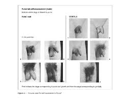 Ingrown hair on vagina is mostly caused by shaving or waxing the wrong way. Puberty Tanner Staging Price Ward M D A