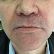 Facial aspect showing crusts in the nose wing and upper left lip.