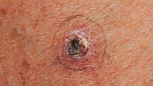 Skin cancer is the most common type of cancer in the united states, with basal and squamous cell skin cancer being the most common carcinoma types. What Is Basal Cell Carcinoma Skin Cancer Everyday Health