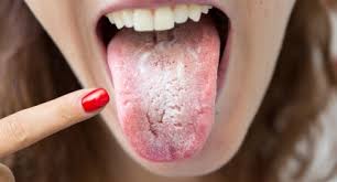 Image result for mouth ulcer on tongue)