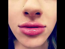 Lips by Lebowitz, Lip Injections and Augmentation, Jonathan Lebowitz MD,  Long Island, NY