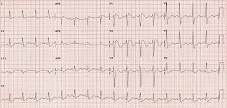 Contrary to popular belief, they're filled with fat, which. Brugada Syndrome Litfl Ecg Library Diagnosis