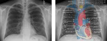 Chest radiographs are the most common film taken in medicine. Chest Xray Anatomy Labeled Clinical Medicalschool